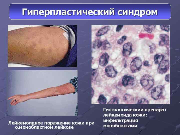 Синдром ошпаренной кожи фото