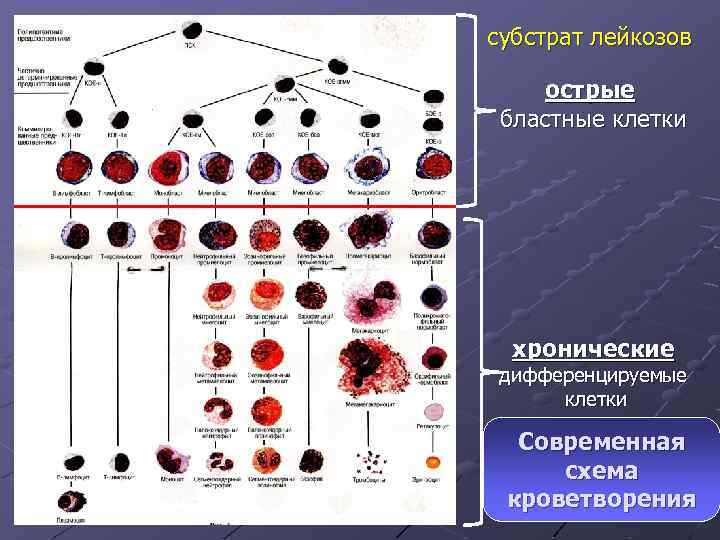 Кровь дифференцировка. Схема кроветворения лейкозы. Лейкоз схема гемопоэза. Схема кроветворения гистология. Система кроветворения при лейкозах.