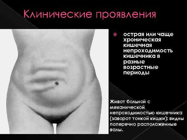 Клинические проявления острая или чаще хроническая кишечная непроходимость кишечника в разные возрастные периоды Живот