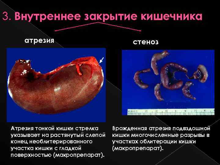 3. Внутреннее закрытие кишечника атрезия Атрезия тонкой кишки стрелка указывает на растянутый слепой конец