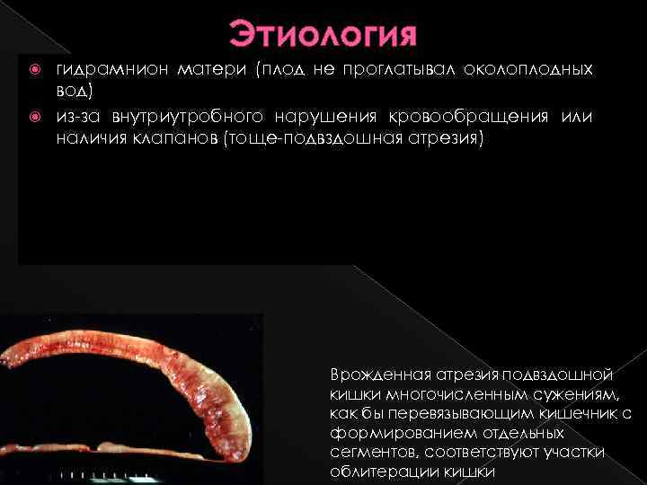 Этиология гидрамнион матери (плод не проглатывал околоплодных вод) из-за внутриутробного нарушения кровообращения или наличия