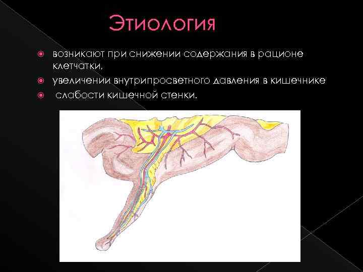 Этиология возникают при снижении содержания в рационе клетчатки, увеличении внутрипросветного давления в кишечнике слабости