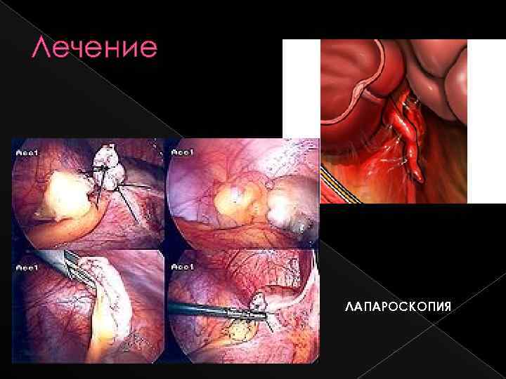 Лечение ЛАПАРОСКОПИЯ 