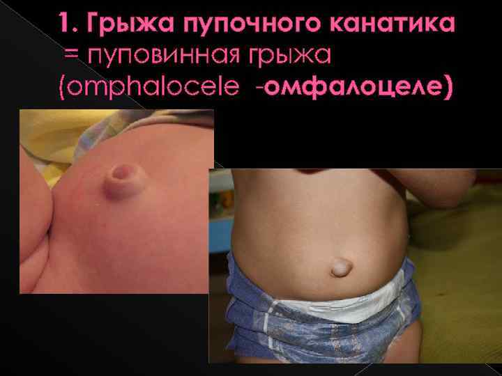 1. Грыжа пупочного канатика = пуповинная грыжа (omphalocele -омфалоцеле) 