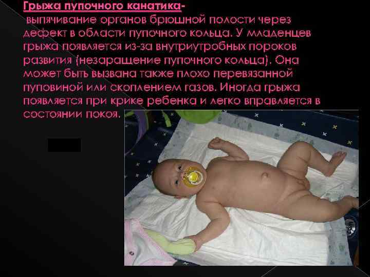 Грыжа пупочного канатикавыпячивание органов брюшной полости через дефект в области пупочного кольца. У младенцев