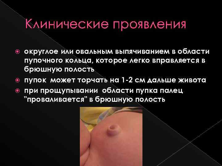 Клинические проявления округлое или овальным выпячиванием в области пупочного кольца, которое легко вправляется в