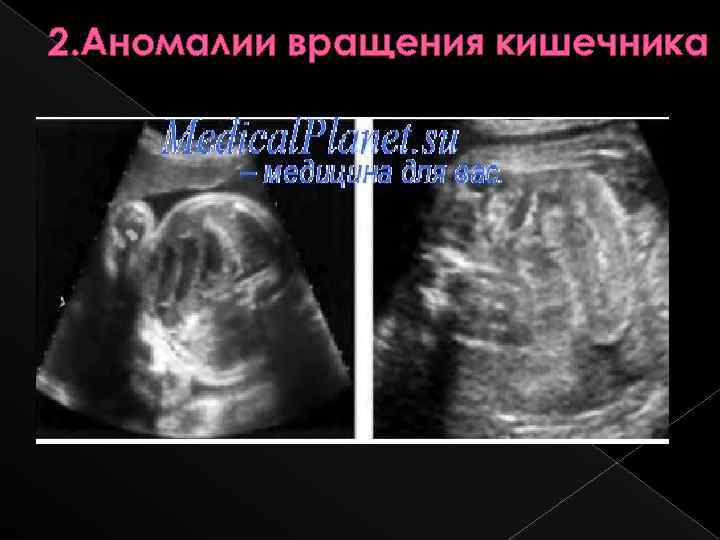 2. Аномалии вращения кишечника 