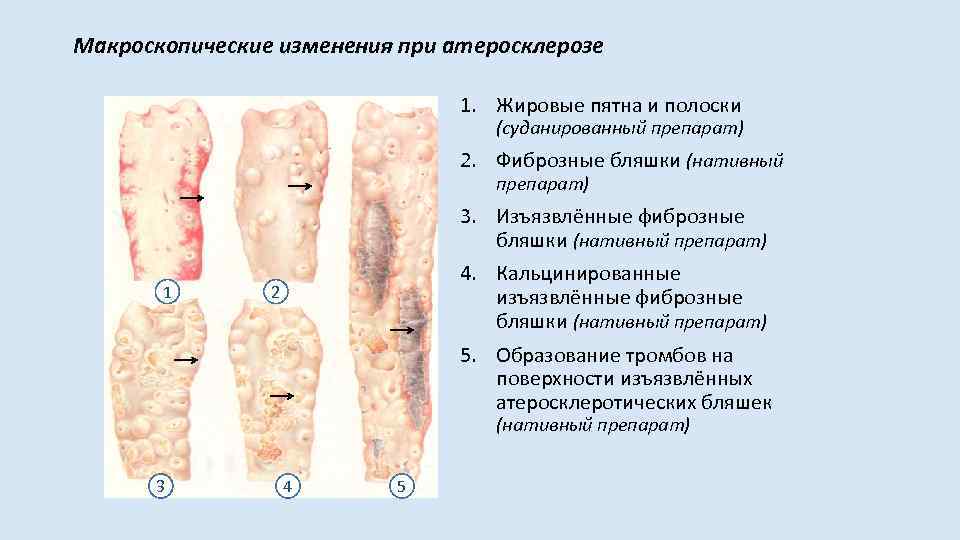 Макроскопические изменения при атеросклерозе 1. Жировые пятна и полоски (суданированный препарат) 2. Фиброзные бляшки