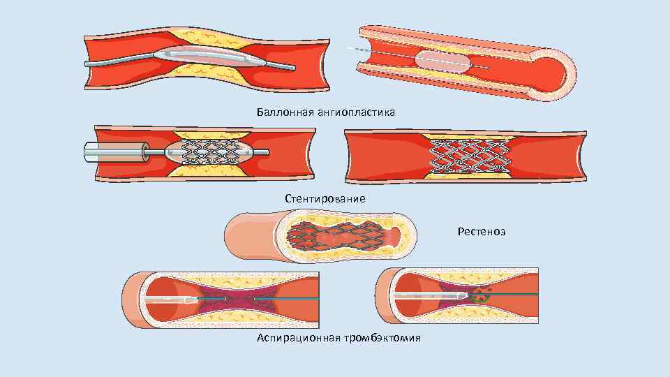 Ангиопластика что это такое. Баллонная ангиопластика и стентирование. Баллонная ангиопластика без стентирования. Чрескожная ТРАНСЛЮМИНАЛЬНАЯ аспирационная тромбэктомия. Баллонная вазодилатация (ангиопластика периферических артерий).