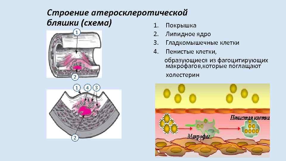 Строение атеросклеротической бляшки (схема) 1. Покрышка 1 2. Липидное ядро 3. Гладкомышечные клетки 4.