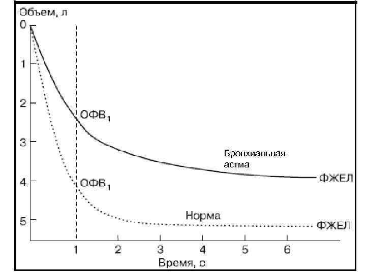 Бронхиальная астма 