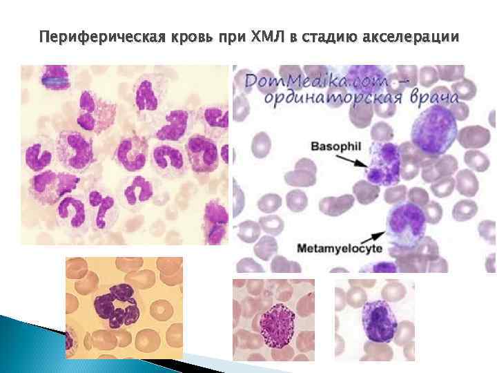 Периферическая кровь при ХМЛ в стадию акселерации 