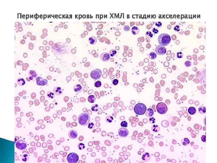 Периферическая кровь при ХМЛ в стадию акселерации 