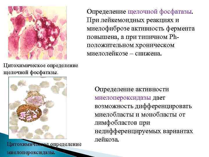 Определение щелочной фосфатазы. При лейкемоидных реакциях и миелофиброзе активность фермента повышена, а при типичном