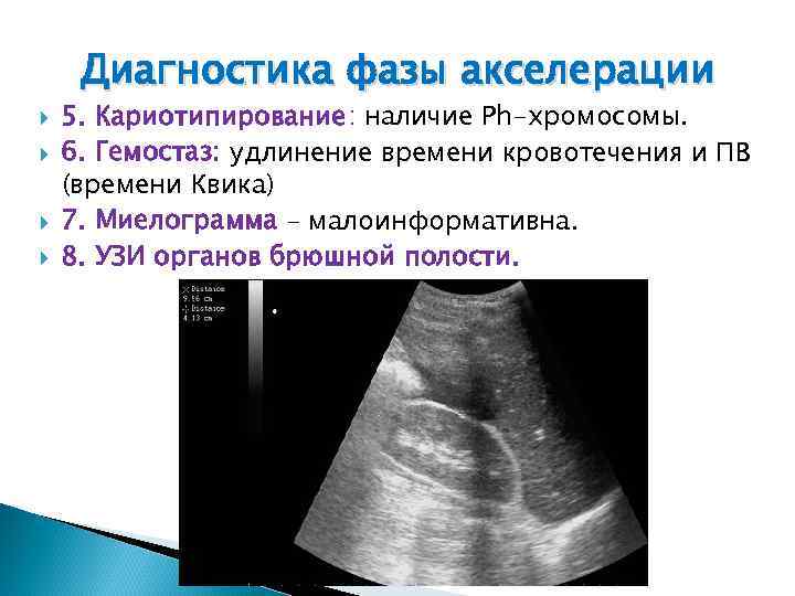 Диагностика фазы акселерации 5. Кариотипирование: наличие Ph-хромосомы. 6. Гемостаз: удлинение времени кровотечения и ПВ