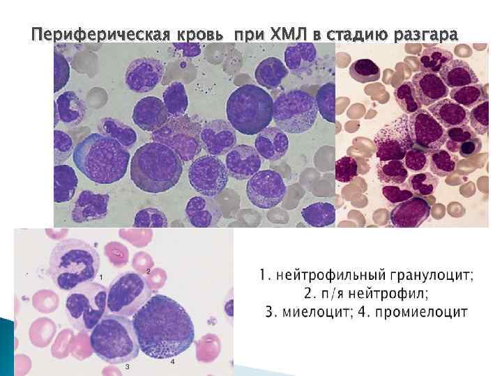 Периферическая кровь при ХМЛ в стадию разгара 