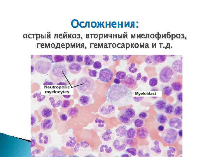 Осложнения: острый лейкоз, вторичный миелофиброз, гемодермия, гематосаркома и т. д. 