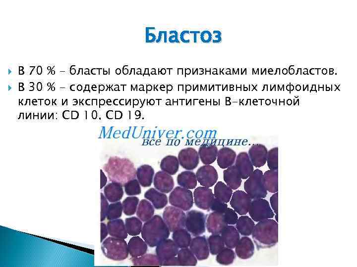 Бластоз В 70 % - бласты обладают признаками миелобластов. В 30 % - содержат