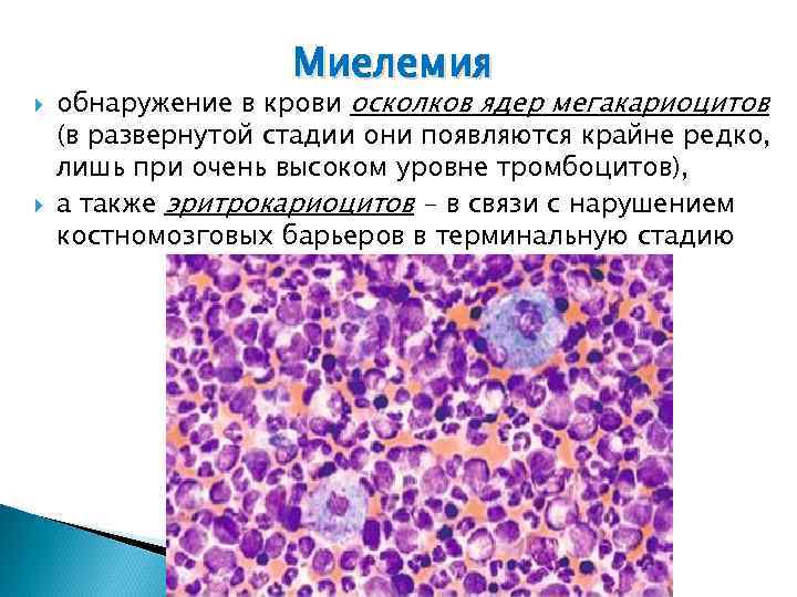  Миелемия обнаружение в крови осколков ядер мегакариоцитов (в развернутой стадии они появляются крайне