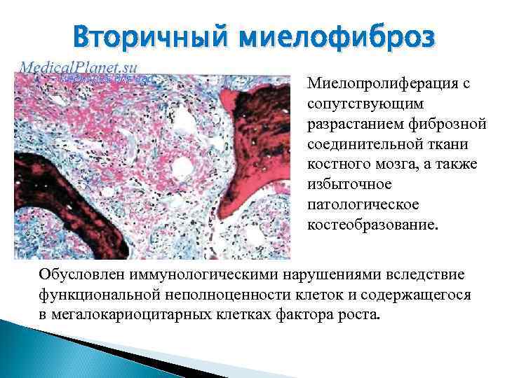 Вторичный миелофиброз Миелопролиферация с сопутствующим разрастанием фиброзной соединительной ткани костного мозга, а также избыточное