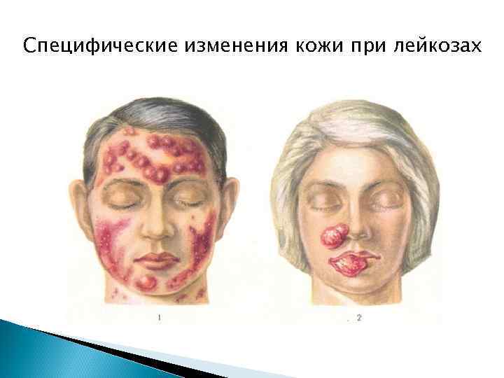 Специфические изменения кожи при лейкозах 