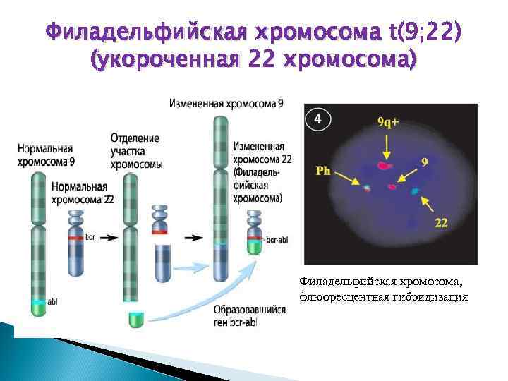 Филадельфийская хромосома t(9; 22) (укороченная 22 хромосома) Филадельфийская хромосома, флюоресцентная гибридизация 