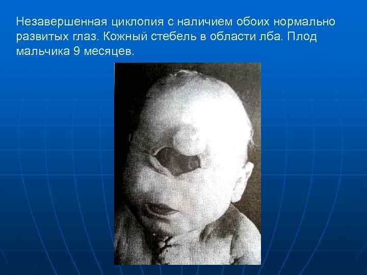 Незавершенная циклопия с наличием обоих нормально развитых глаз. Кожный стебель в области лба. Плод