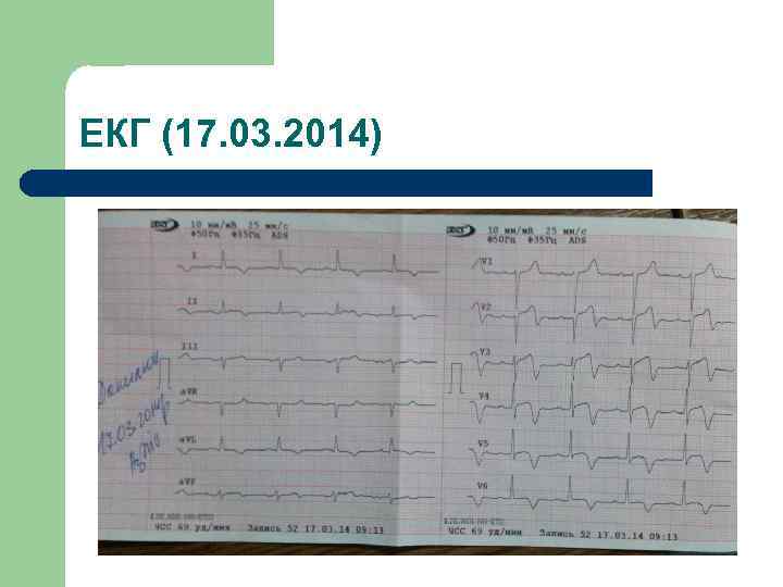 ЕКГ (17. 03. 2014) 
