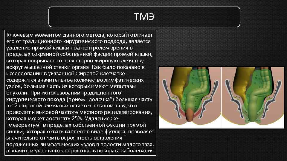 ТМЭ Ключевым моментом данного метода, который отличает его от традиционного хирургического подхода, является удаление