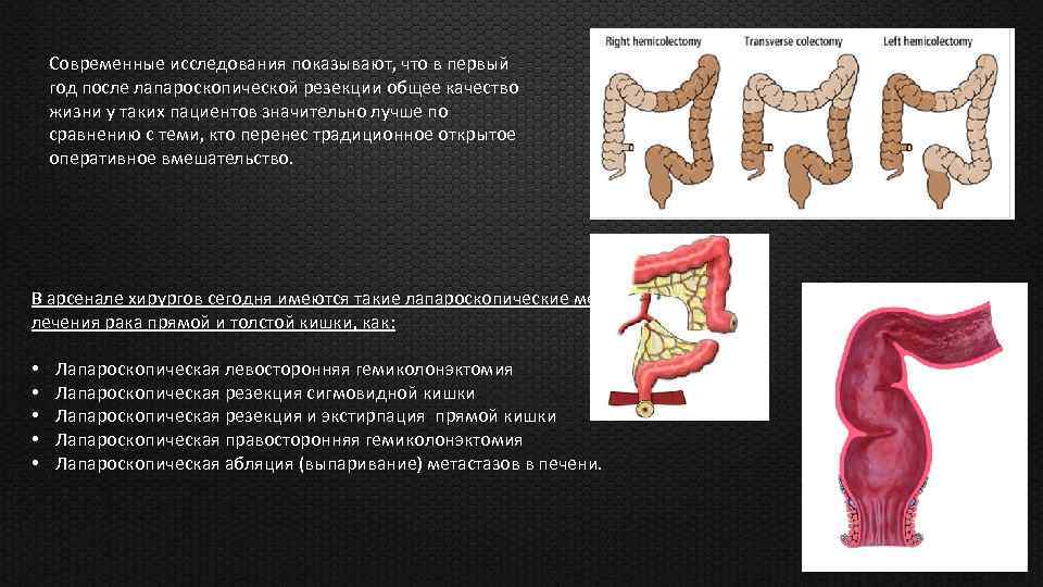 Современные исследования показывают, что в первый год после лапароскопической резекции общее качество жизни у