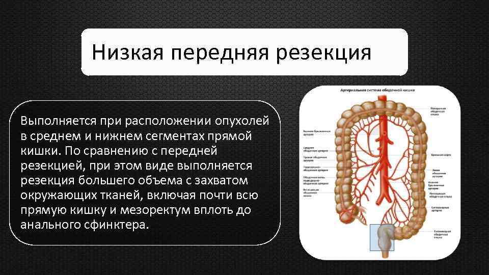 Низкая передняя резекция Выполняется при расположении опухолей в среднем и нижнем сегментах прямой кишки.