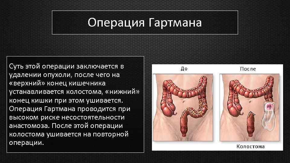 Операция Гартмана Суть этой операции заключается в удалении опухоли, после чего на «верхний» конец