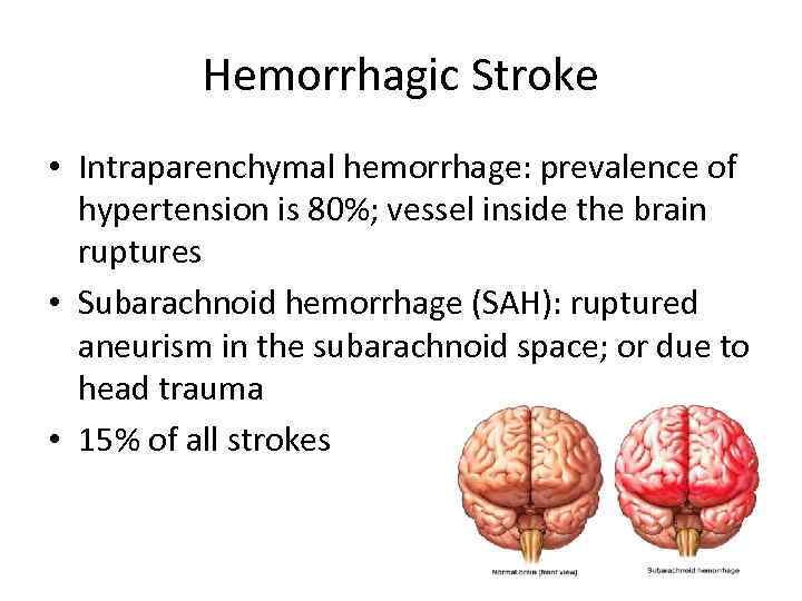 Hemorrhagic Stroke • Intraparenchymal hemorrhage: prevalence of hypertension is 80%; vessel inside the brain