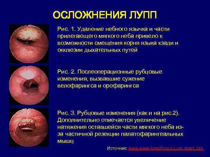 ОСЛОЖНЕНИЯ ЛУПП Рис. 1. Удаление небного язычка и части прилегающего мягкого неба привело к