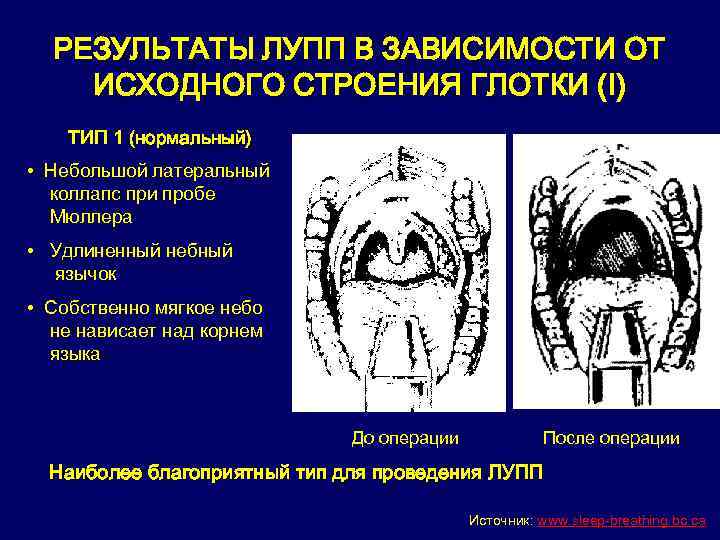 РЕЗУЛЬТАТЫ ЛУПП В ЗАВИСИМОСТИ ОТ ИСХОДНОГО СТРОЕНИЯ ГЛОТКИ (I) ТИП 1 (нормальный) • Небольшой