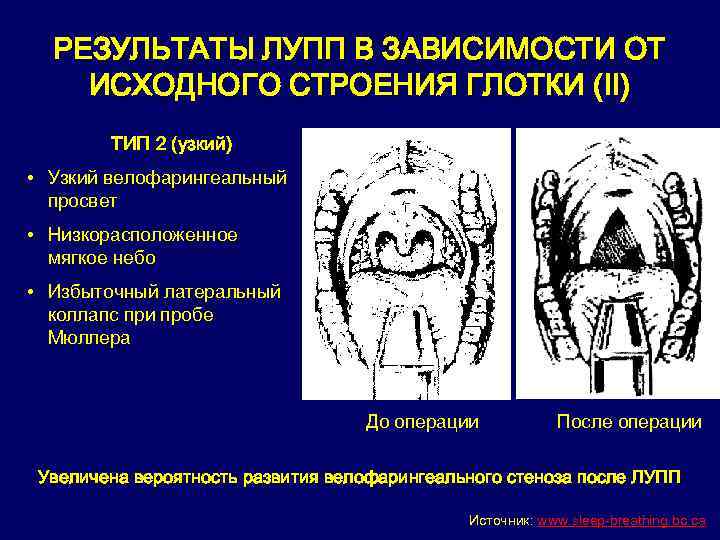 РЕЗУЛЬТАТЫ ЛУПП В ЗАВИСИМОСТИ ОТ ИСХОДНОГО СТРОЕНИЯ ГЛОТКИ (II) ТИП 2 (узкий) • Узкий