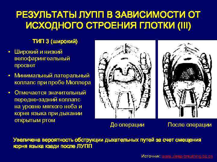 РЕЗУЛЬТАТЫ ЛУПП В ЗАВИСИМОСТИ ОТ ИСХОДНОГО СТРОЕНИЯ ГЛОТКИ (III) ТИП 3 (широкий) • Широкий