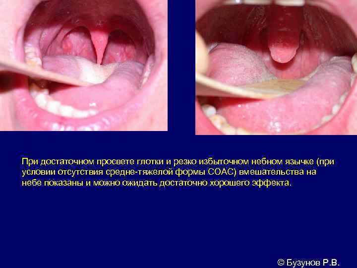 При достаточном просвете глотки и резко избыточном небном язычке (при условии отсутствия средне-тяжелой формы