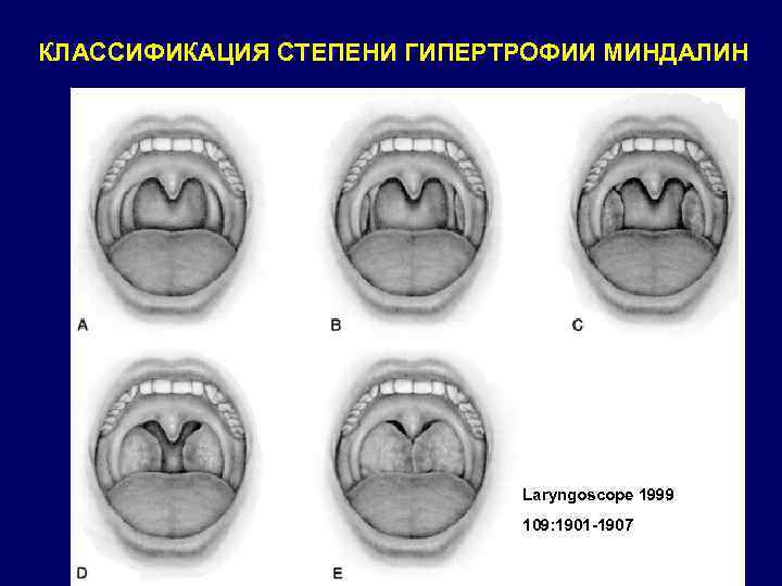 КЛАССИФИКАЦИЯ СТЕПЕНИ ГИПЕРТРОФИИ МИНДАЛИН Laryngoscope 1999 109: 1901 -1907 