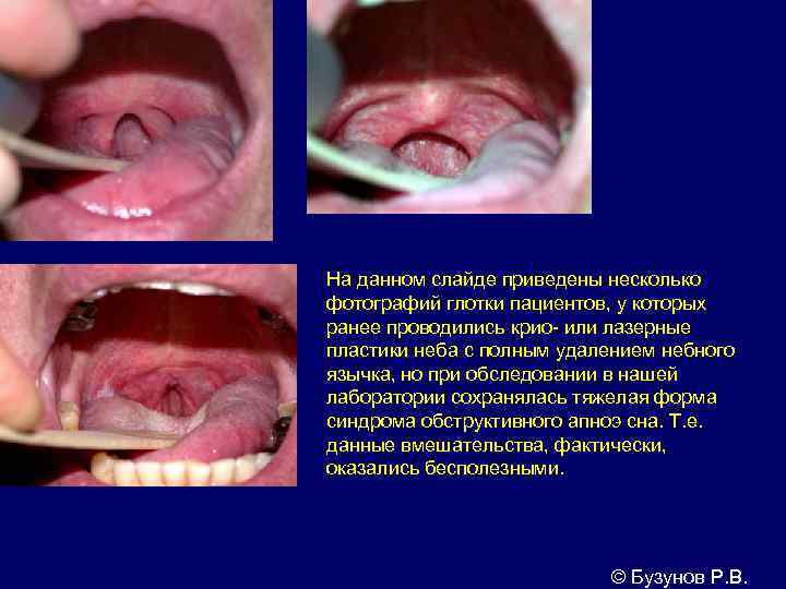 На данном слайде приведены несколько фотографий глотки пациентов, у которых ранее проводились крио- или