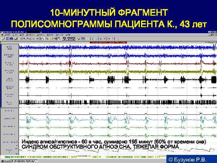 10 -МИНУТНЫЙ ФРАГМЕНТ ПОЛИСОМНОГРАММЫ ПАЦИЕНТА К. , 43 лет Индекс апноэ/гипопноэ - 60 в