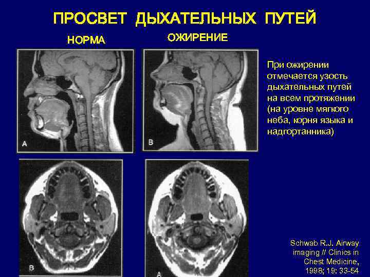 ПРОСВЕТ ДЫХАТЕЛЬНЫХ ПУТЕЙ НОРМА ОЖИРЕНИЕ При ожирении отмечается узость дыхательных путей на всем протяжении