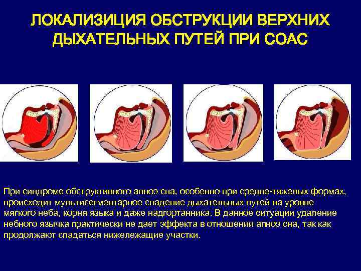 ЛОКАЛИЗИЦИЯ ОБСТРУКЦИИ ВЕРХНИХ ДЫХАТЕЛЬНЫХ ПУТЕЙ ПРИ СОАС При синдроме обструктивного апноэ сна, особенно при