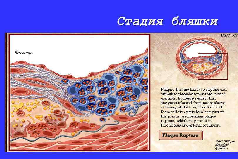 Стадия бляшки 
