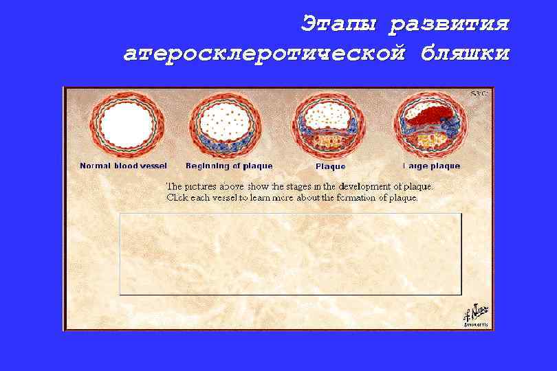 Этапы развития атеросклеротической бляшки 