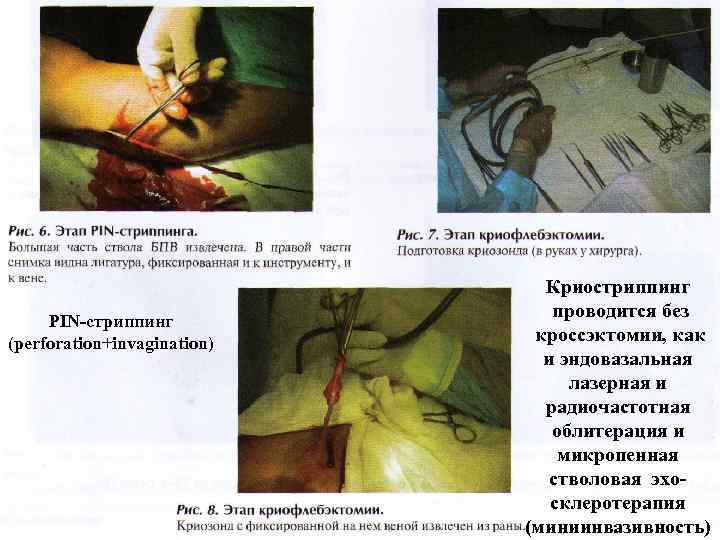 РIN-стриппинг (perforation+invagination) Криостриппинг проводится без кроссэктомии, как и эндовазальная лазерная и радиочастотная облитерация и