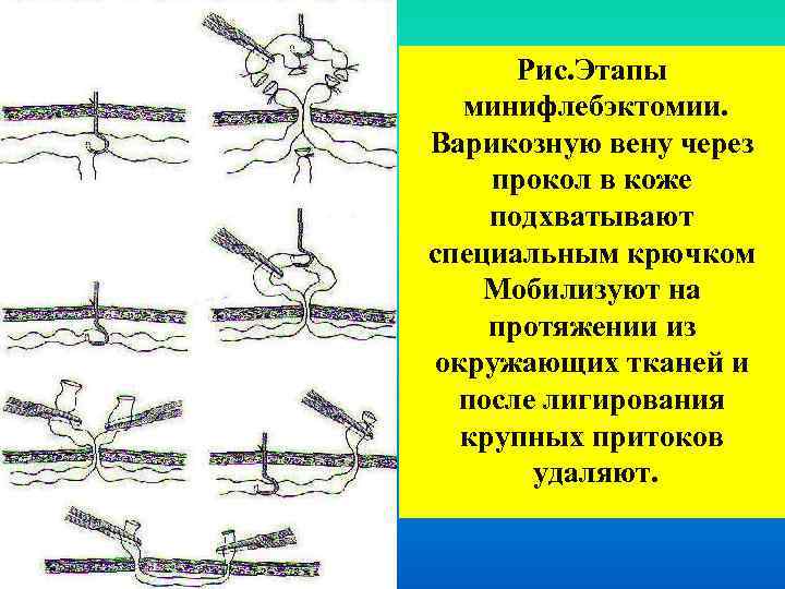 Варикоз корнилова схема