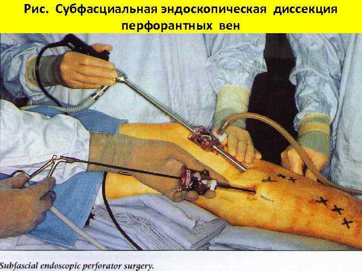 Рис. Субфасциальная эндоскопическая диссекция перфорантных вен 