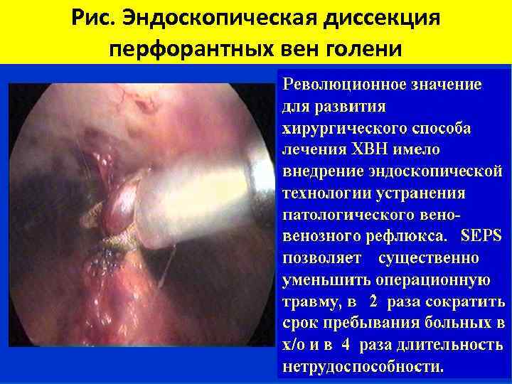 Рис. Эндоскопическая диссекция перфорантных вен голени 