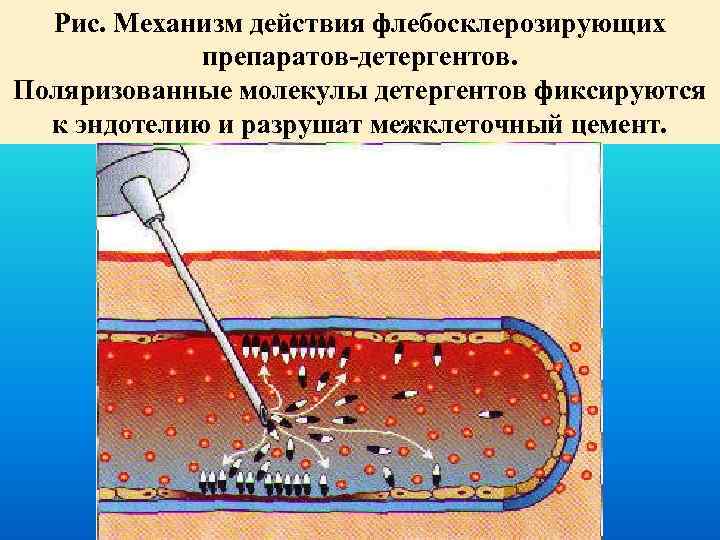 Рис. Механизм действия флебосклерозирующих препаратов-детергентов. Поляризованные молекулы детергентов фиксируются к эндотелию и разрушат межклеточный